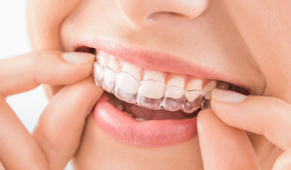 alinhador dentario transparente