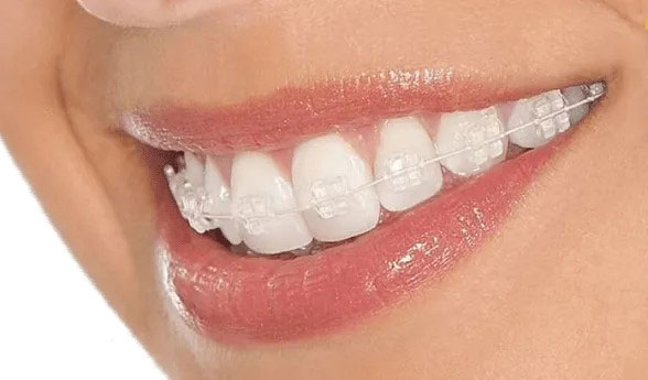 aparelho dentario de safira