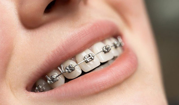 aparelho dentario metalico