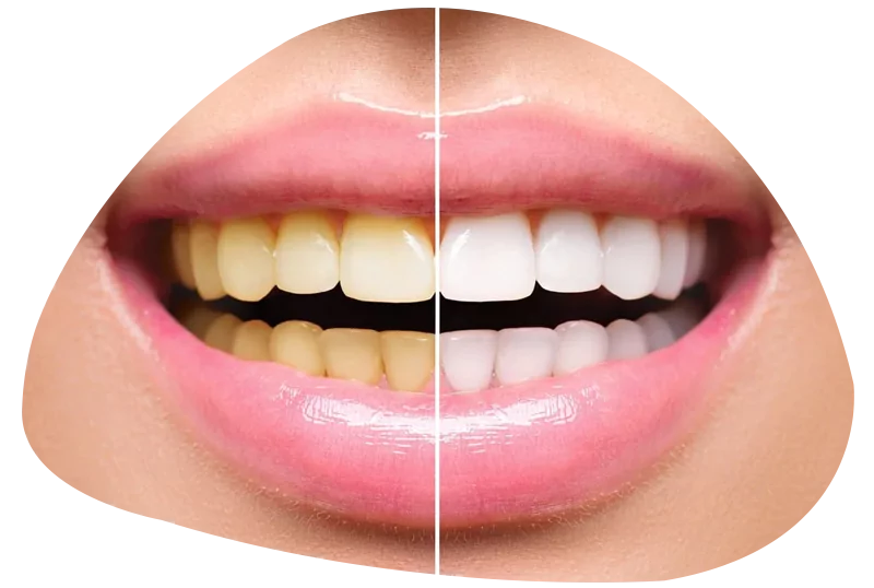 clareamento dental