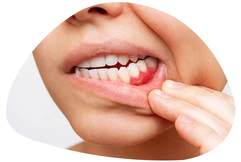 tratamento de gengivas periodontia